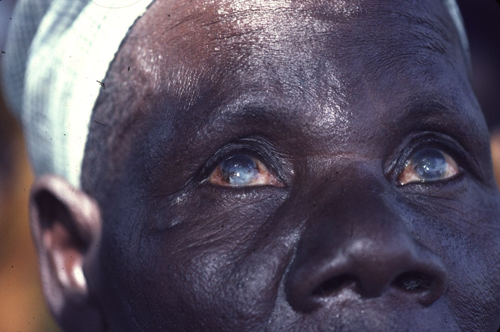 Keratite Scl Bilat LowR - L’Organisation pour la Prévention de la Cécité (OPC) encourage le renforcement des systèmes de santé oculaire et lutte pour le droit à la vue des populations les plus négligées en Afrique francophone.