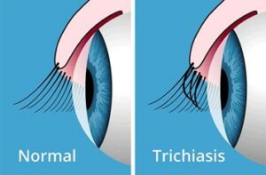 tackling trachoma in Chad, Africa: Diagram comparing a healthy eye and an eye affected by trichiasis.